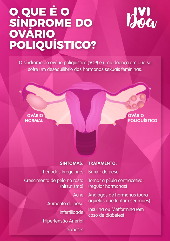 Menstruação irregular e SOP: Como regular?