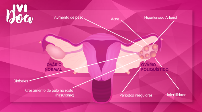 sindrome ovario policisto